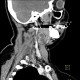 Inflammatory lymph node with liquefaction: CT - Computed tomography